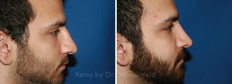 Patient 7696, Rhinoplasty Before and After Photos Rhinoplasty Before and After Photos in DC, Patient 7696