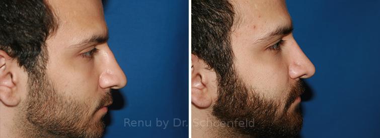 Rhinoplasty Before and After Photos in DC, Patient 7696