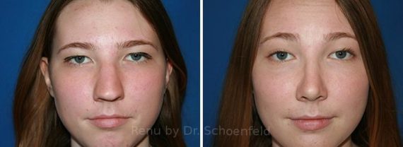 Rhinoplasty Before and After Photos in DC, Patient 7701