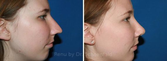 Rhinoplasty Before and After Photos in DC, Patient 7701