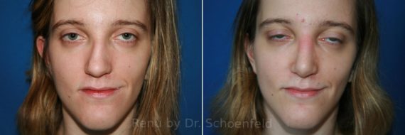 Rhinoplasty Before and After Photos in DC, Patient 8580