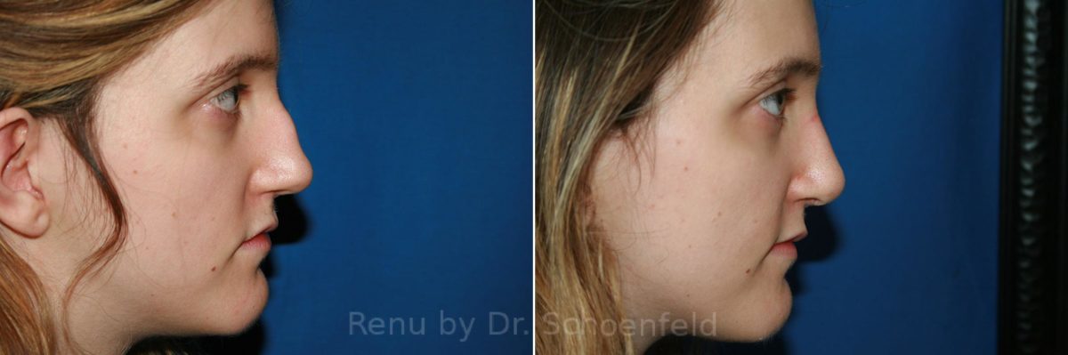Rhinoplasty Before and After Photos in DC, Patient 8580