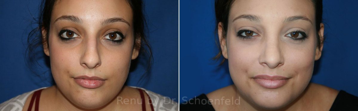 Rhinoplasty Before and After Photos in DC, Patient 8547