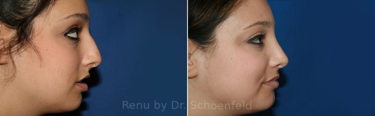 Rhinoplasty Before and After Photos in DC, Patient 8547
