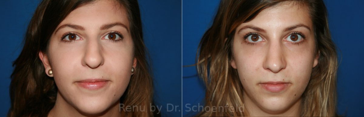 Rhinoplasty Before and After Photos in DC, Patient 8516