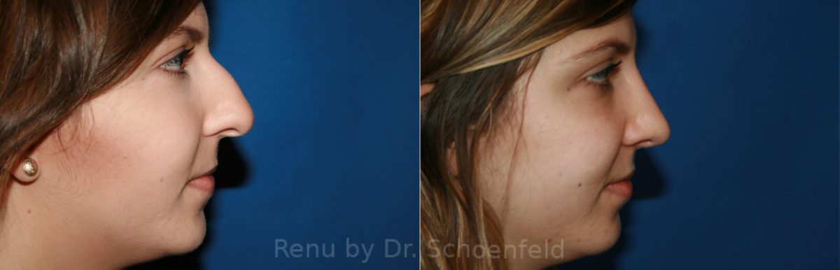 Rhinoplasty Before and After Photos in DC, Patient 8516