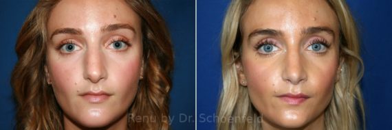 Rhinoplasty Before and After Photos in DC, Patient 7726