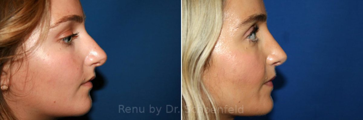 Rhinoplasty Before and After Photos in DC, Patient 7726