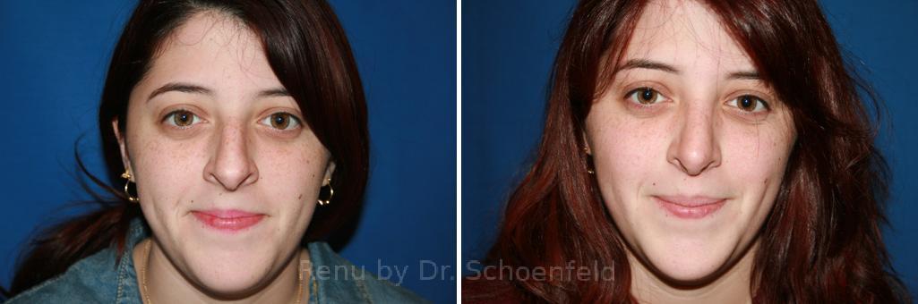 Rhinoplasty Before and After Photos in DC, Patient 7591