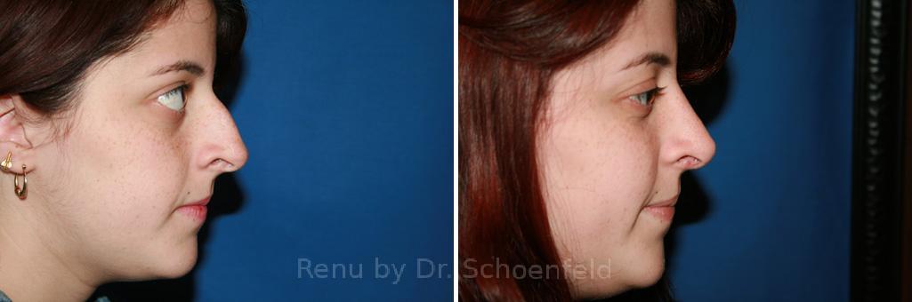 Rhinoplasty Before and After Photos in DC, Patient 7591