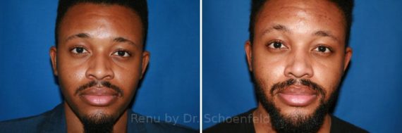 Rhinoplasty Before and After Photos in DC, Patient 7596