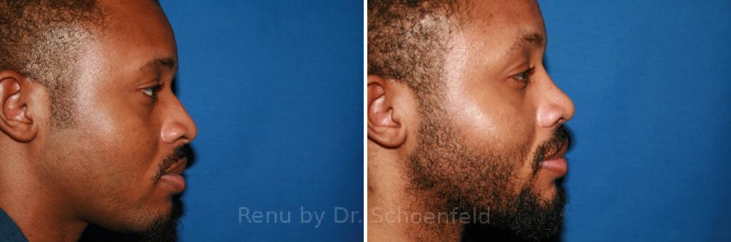 Rhinoplasty Before and After Photos in DC, Patient 7596