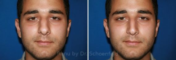 Rhinoplasty Before and After Photos in DC, Patient 7601