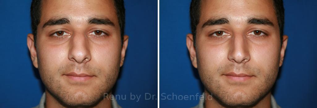 Rhinoplasty Before and After Photos in DC, Patient 7601