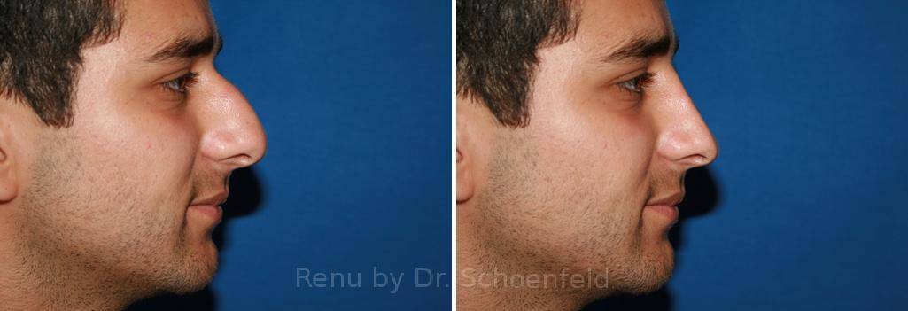 Rhinoplasty Before and After Photos in DC, Patient 7601