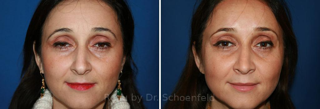Rhinoplasty Before and After Photos in DC, Patient 7606