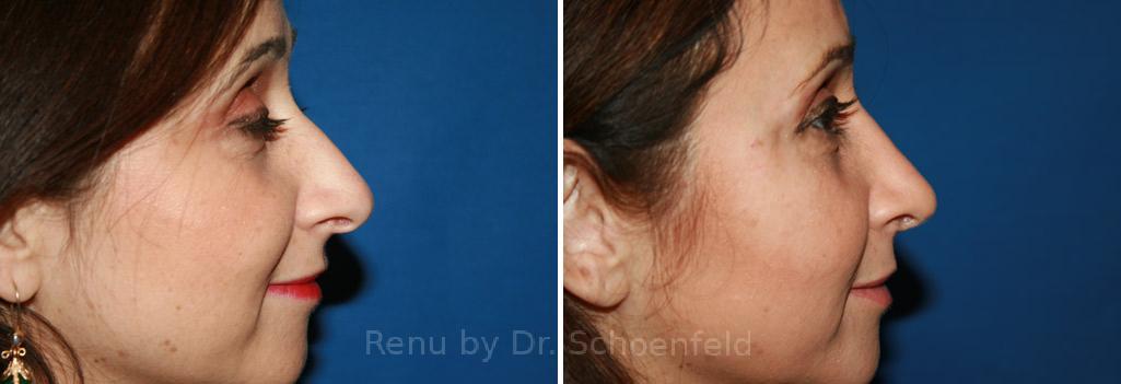 Rhinoplasty Before and After Photos in DC, Patient 7606