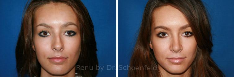 Rhinoplasty Before and After Photos in DC, Patient 7611