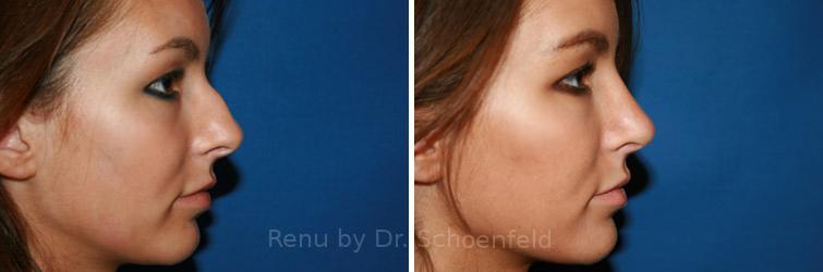 Rhinoplasty Before and After Photos in DC, Patient 7611