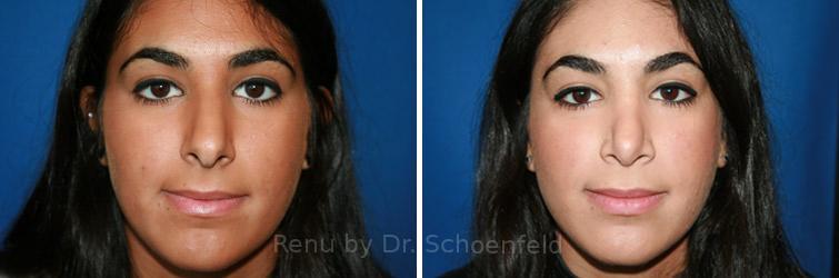 Rhinoplasty Before and After Photos in DC, Patient 7616