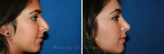 Rhinoplasty Before and After Photos in DC, Patient 7616