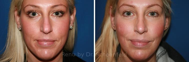 Rhinoplasty Before and After Photos in DC, Patient 7711
