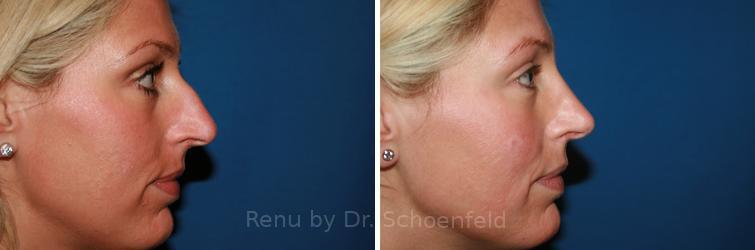 Rhinoplasty Before and After Photos in DC, Patient 7711