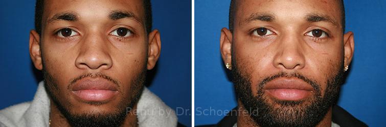 Rhinoplasty Before and After Photos in DC, Patient 7706