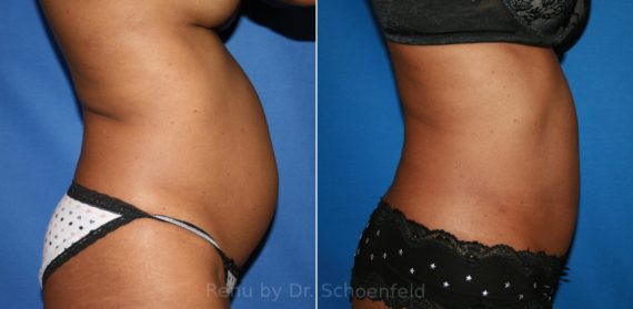 Slimlipo - Laser Liposuction Before and After Photos in DC, Patient 8488