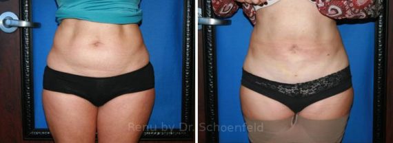 Slimlipo - Laser Liposuction Before and After Photos in DC, Patient 7748