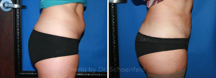 Slimlipo - Laser Liposuction Before and After Photos in DC, Patient 7748