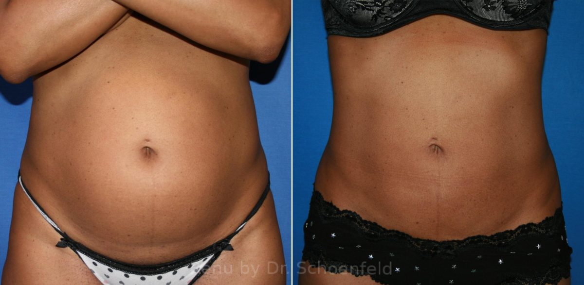 Slimlipo - Laser Liposuction Before and After Photos in DC, Patient 8488