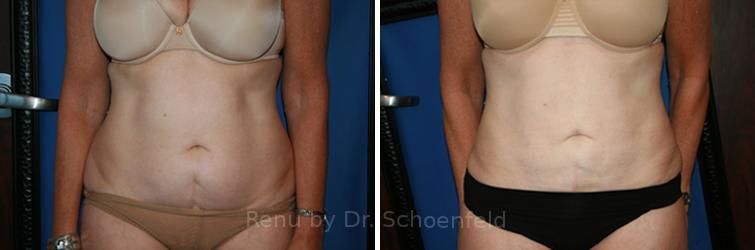 Slimlipo - Laser Liposuction Before and After Photos in DC, Patient 7753