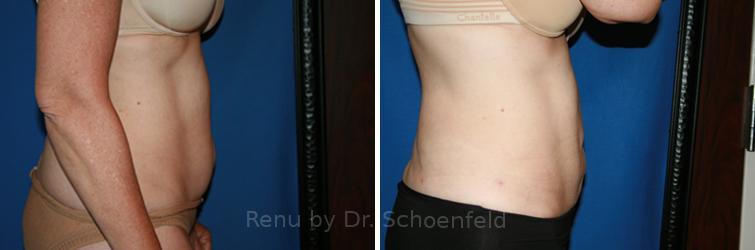 Slimlipo - Laser Liposuction Before and After Photos in DC, Patient 7753