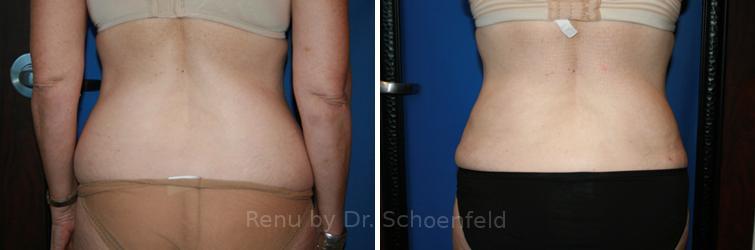 Laser Liposuction BBL Before and After