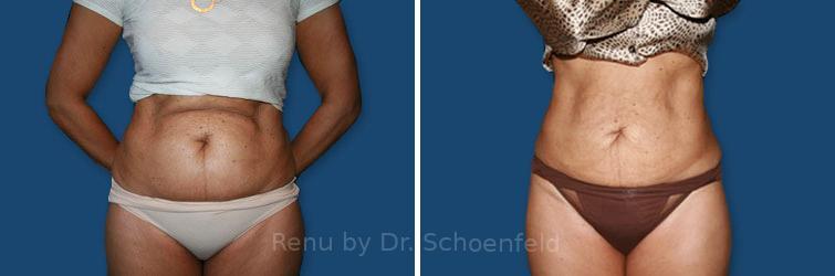 Liposuction Before & After Gallery: Patient 16