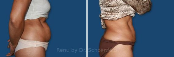 Slimlipo - Laser Liposuction Before and After Photos in DC, Patient 7760