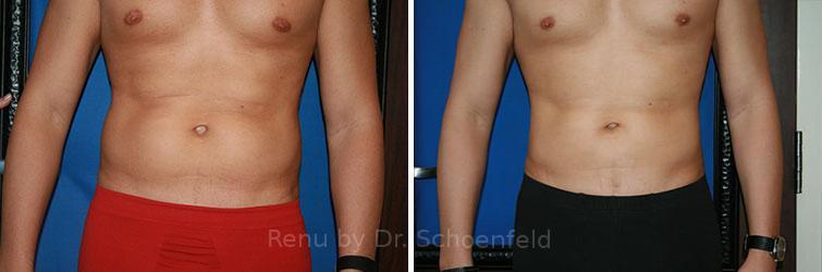 Slimlipo - Laser Liposuction Before and After Photos in DC, Patient 7765