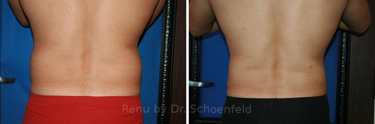 Slimlipo - Laser Liposuction Before and After Photos in DC, Patient 7765