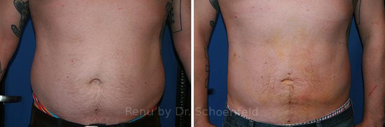 Slimlipo - Laser Liposuction Before and After Photos in DC, Patient 7770