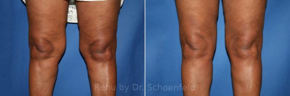 Slimlipo - Laser Liposuction Before and After Photos in DC, Patient 7775