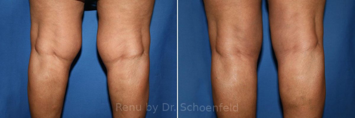 Slimlipo - Laser Liposuction Before and After Photos in DC, Patient 7775