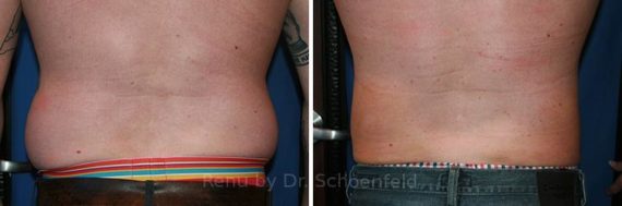 Slimlipo - Laser Liposuction Before and After Photos in DC, Patient 7770