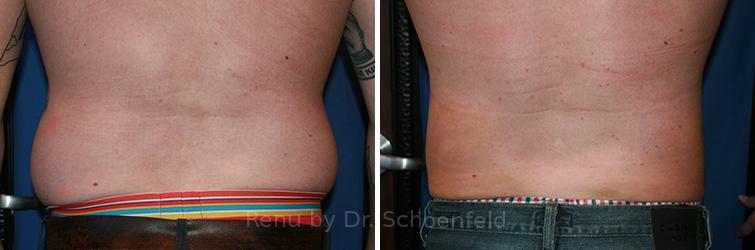 Slimlipo - Laser Liposuction Before and After Photos in DC, Patient 7770