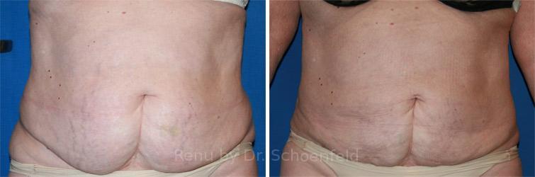 Slimlipo - Laser Liposuction Before and After Photos in DC, Patient 7731