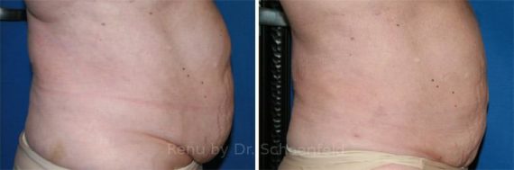 Slimlipo - Laser Liposuction Before and After Photos in DC, Patient 7731