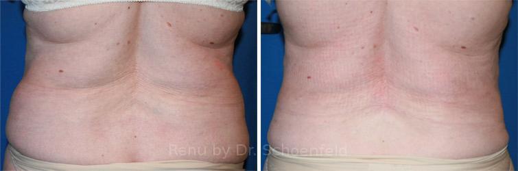 Slimlipo - Laser Liposuction Before and After Photos in DC, Patient 7731
