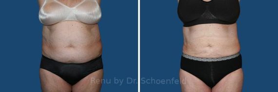 Slimlipo - Laser Liposuction Before and After Photos in DC, Patient 7738