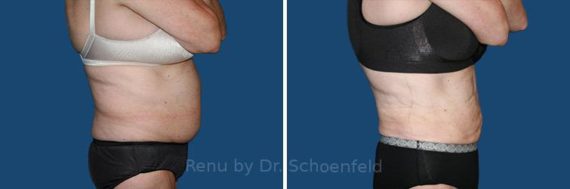 Slimlipo - Laser Liposuction Before and After Photos in DC, Patient 7738
