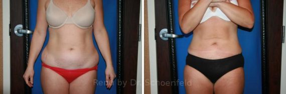 Slimlipo - Laser Liposuction Before and After Photos in Chevy Chase, MD